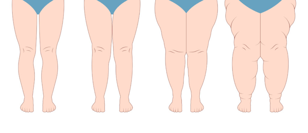 lipedema santagostino sesto