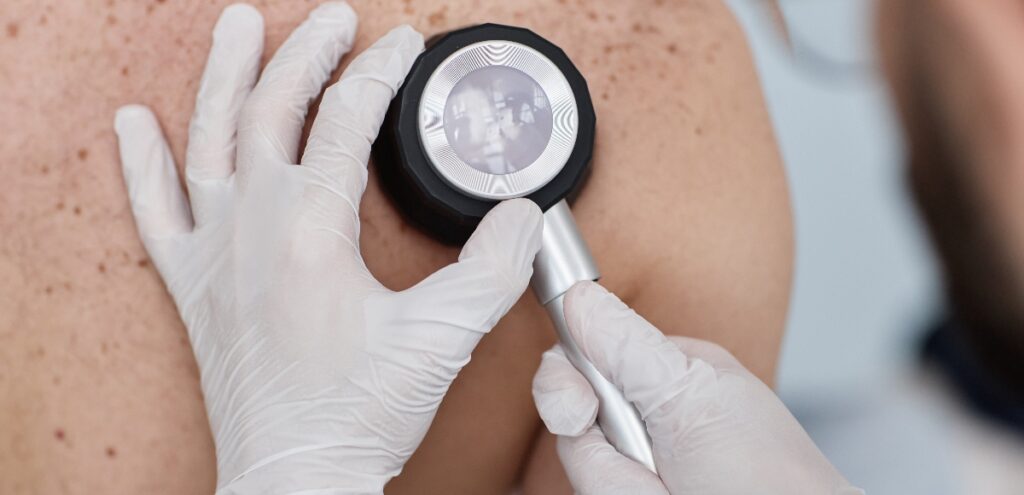 melanoma