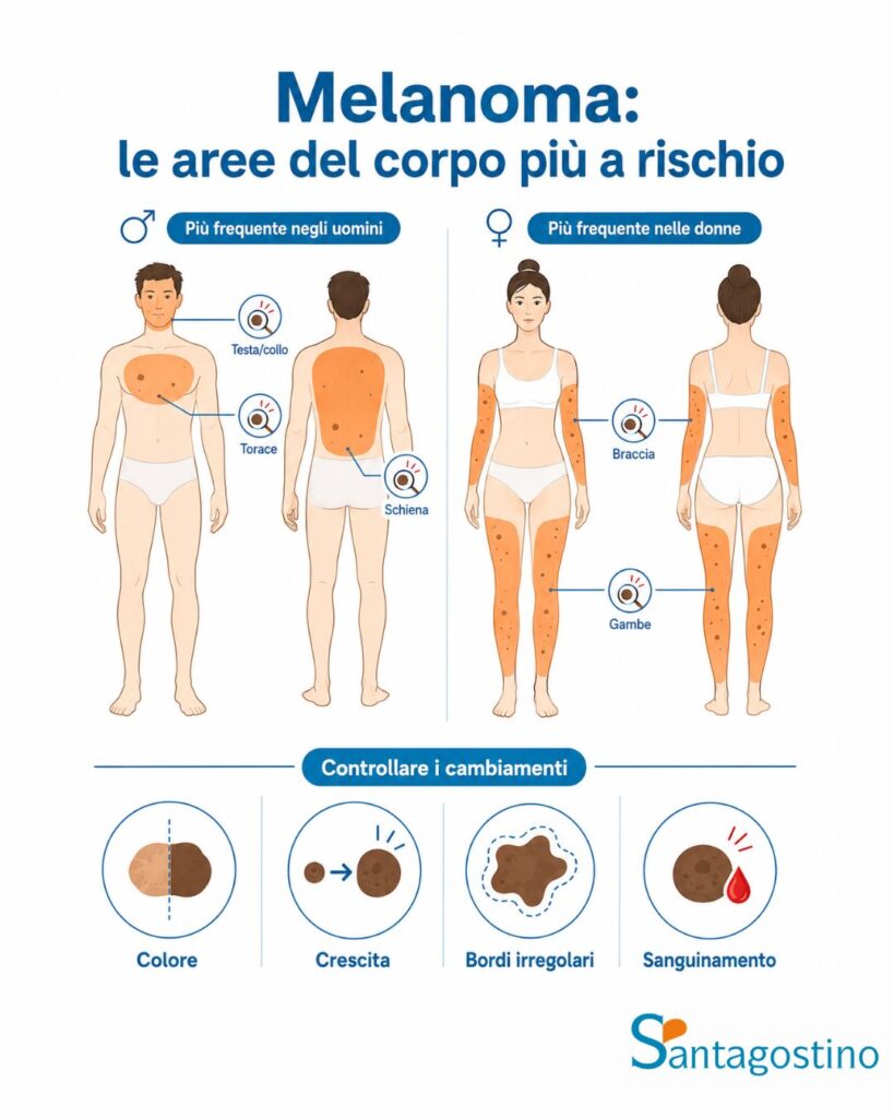 parti del corpo a rischio melanoma