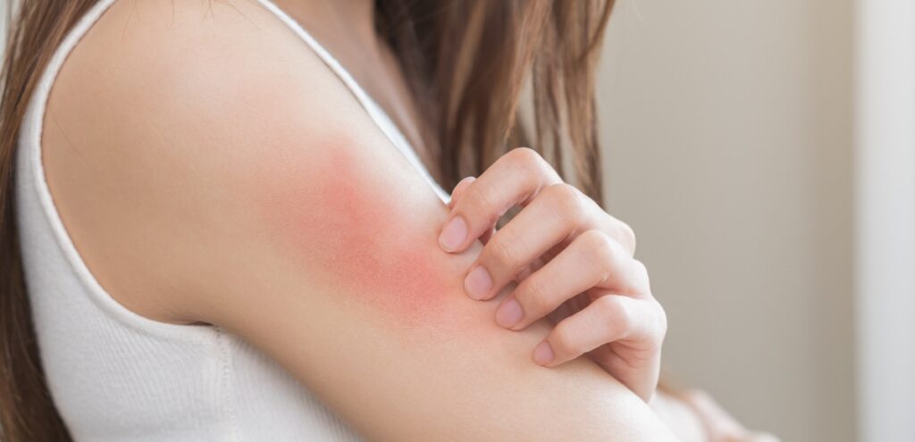 dermatite atopica